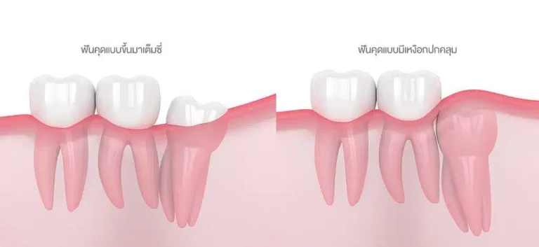 ฟันคุด