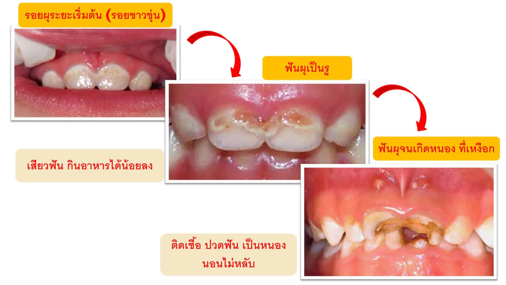 ฟันผุในเด็ก